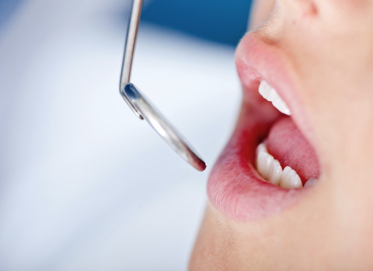 Gingivectomy