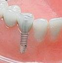 dental implant